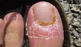 Лечение на гъбички на ноктите
