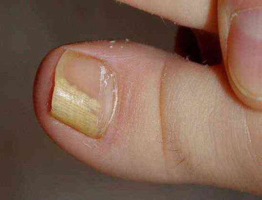 дистална странична форма на гъбички по ноктите