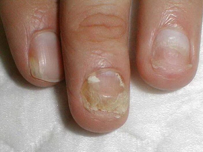 кандидозно лечение на гъбички по ноктите