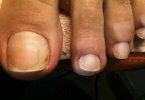 Гъбички на палеца на крака