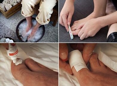 Подпаряване на краката и нанасяне на урея крем върху засегнатите от гъбички нокти