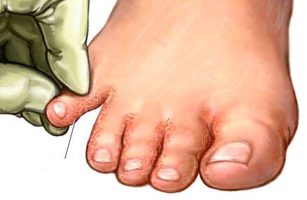 гъбички между пръстите на краката