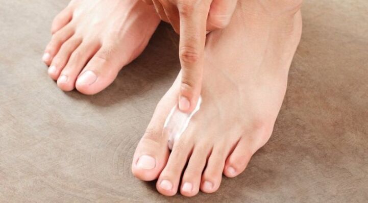 как и как да лекуваме гъбичките между пръстите на краката