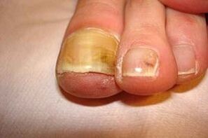 пренебрегвана гъбичка на ноктите на краката