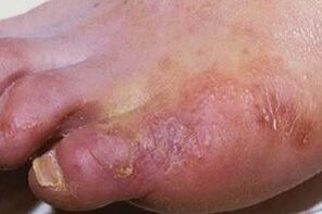 прояви на гъбична инфекция по кожата на краката