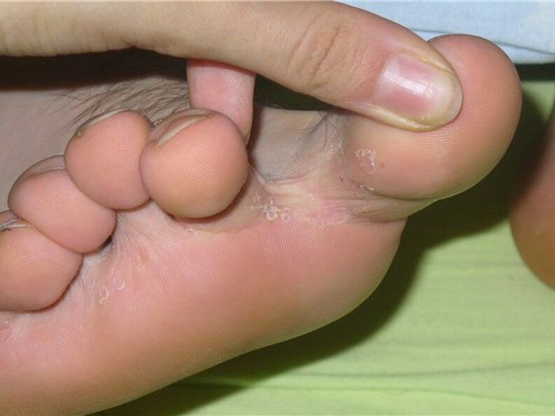 гъбички между пръстите на краката снимка 1