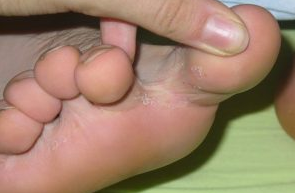 Гъбички между пръстите на краката