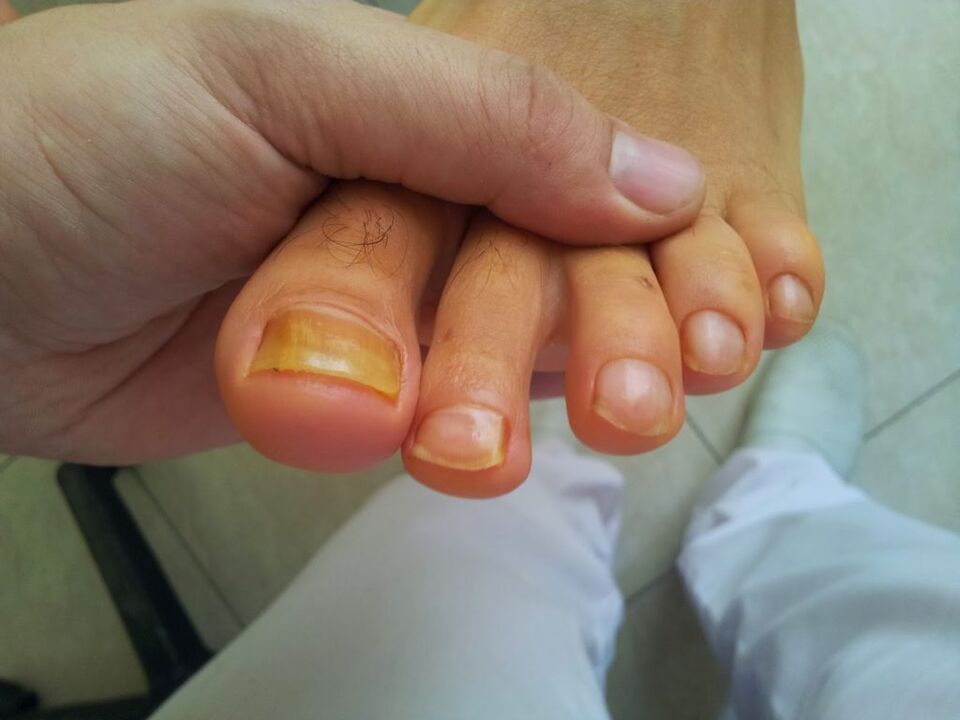 пожълтяване на ноктите на краката с гъбички