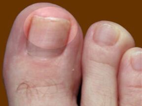 Гъбички по ноктите на краката - индикация за използване на фунгицидни капки