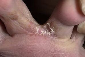 кожни гъбички между пръстите на краката