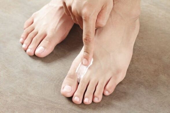 прилагане на мехлем от гъбички на кожата на краката