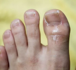 Гъбички на нокътя на големия пръст на