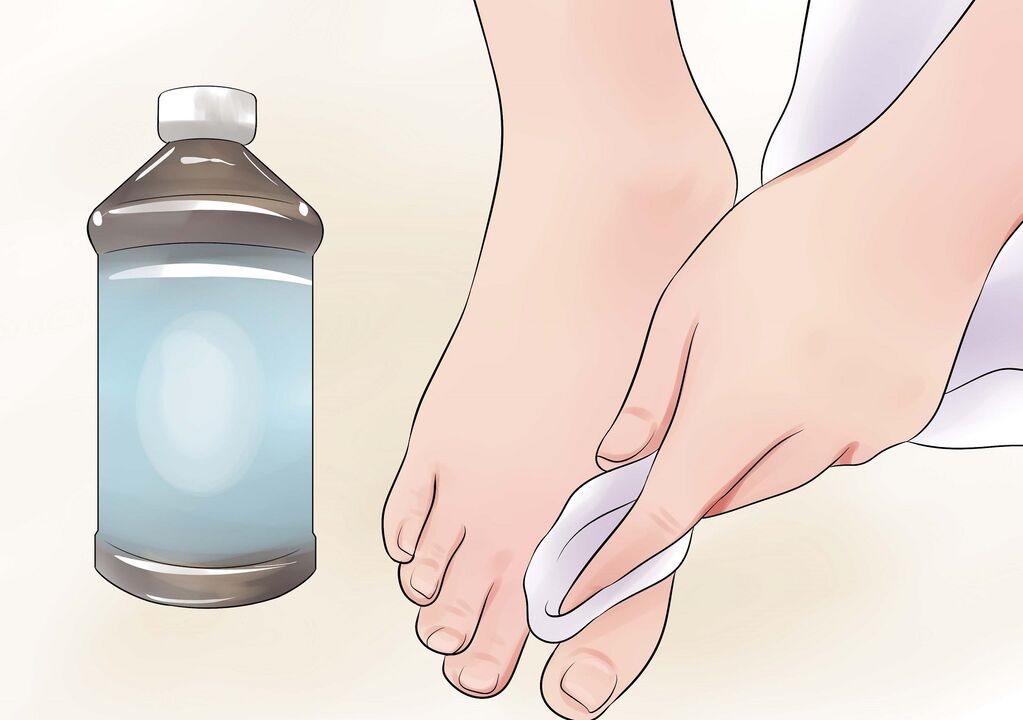 водороден прекис за гъбички по ноктите на краката