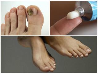 гъбички на ноктите на краката лечение