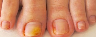 гъбички на ноктите на краката симптоми