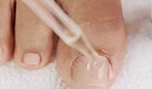 Капки от гъбички на ноктите на краката