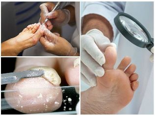 гъбички на кожата на краката диагностика