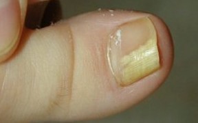 Гъбички на ноктите